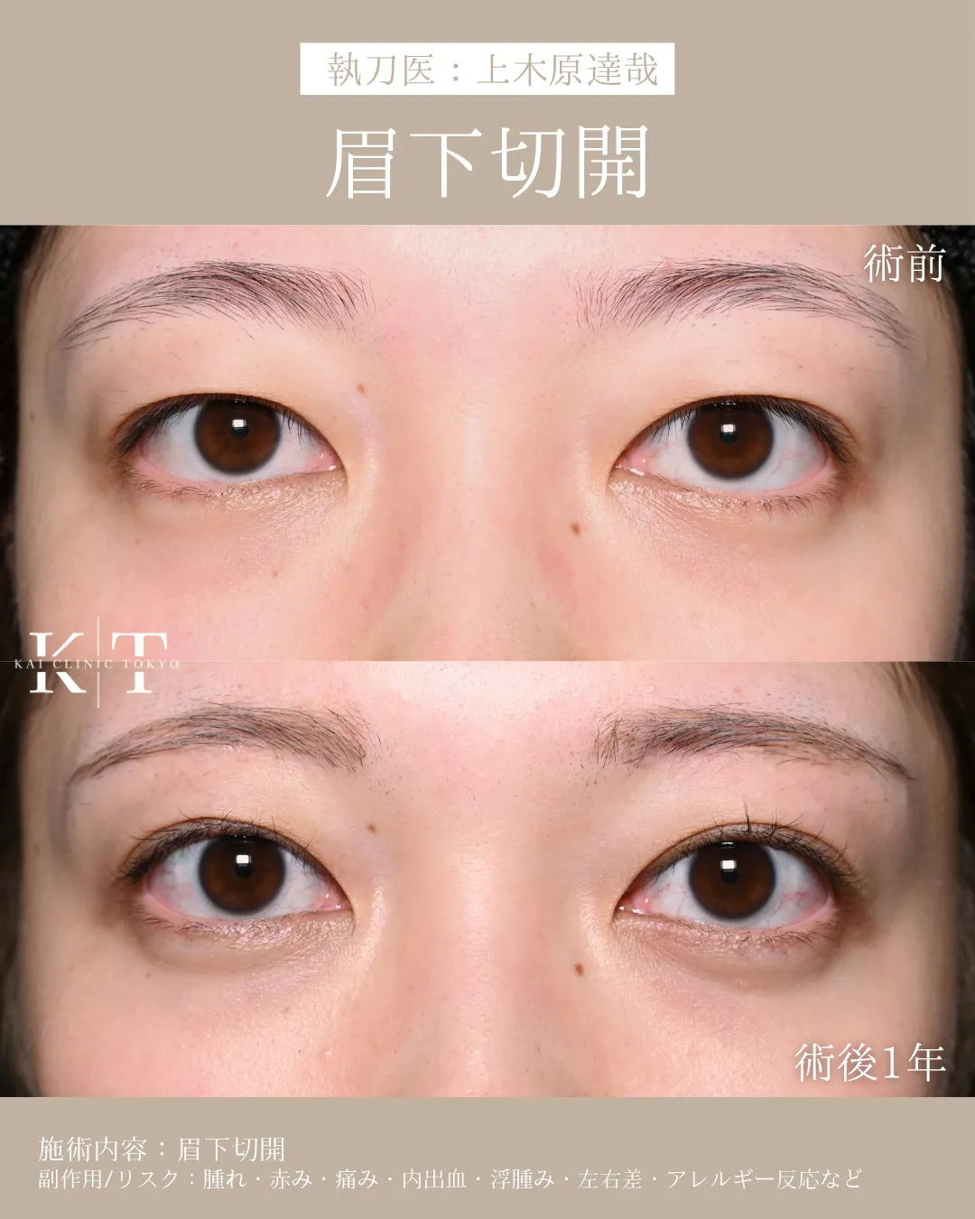 眉下切開【30代女性】