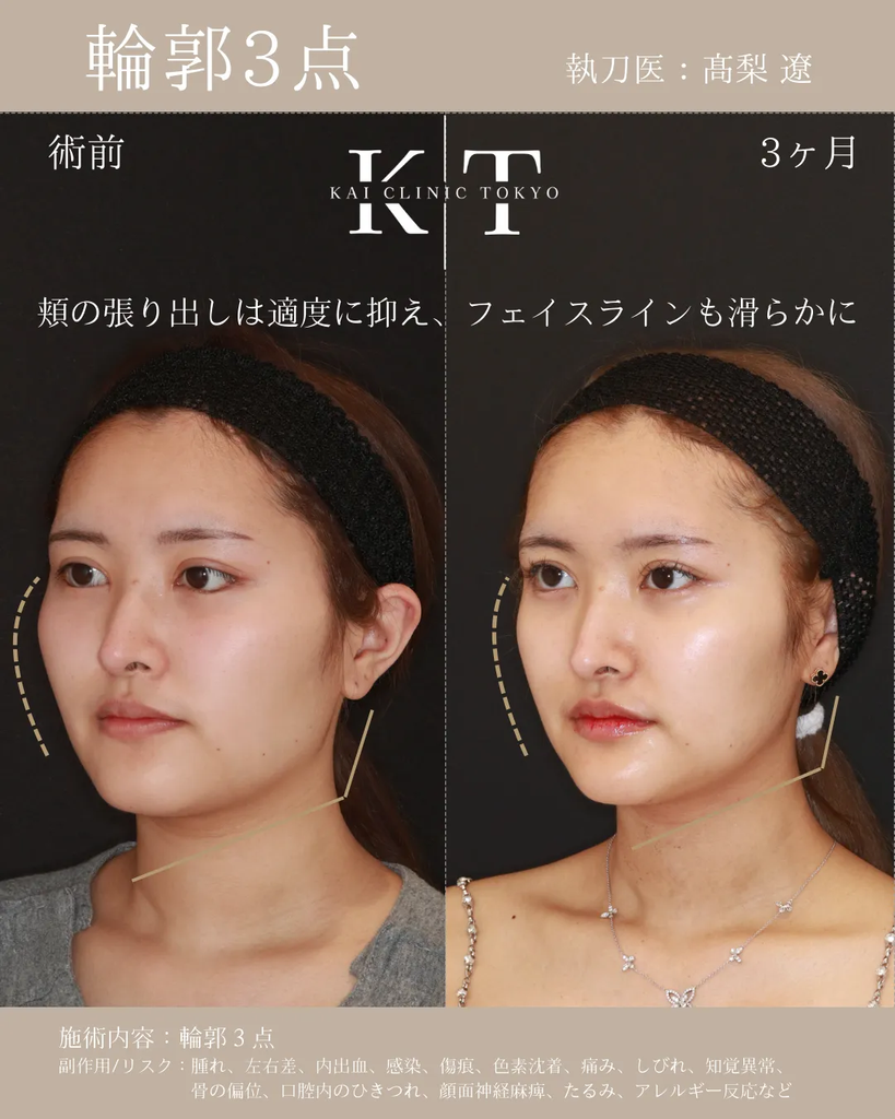 輪郭3点　症例