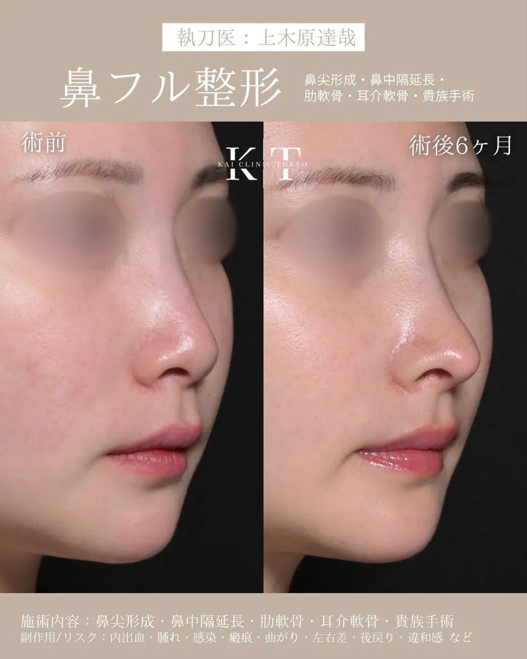 鼻フル整形【30代女性】の症例写真