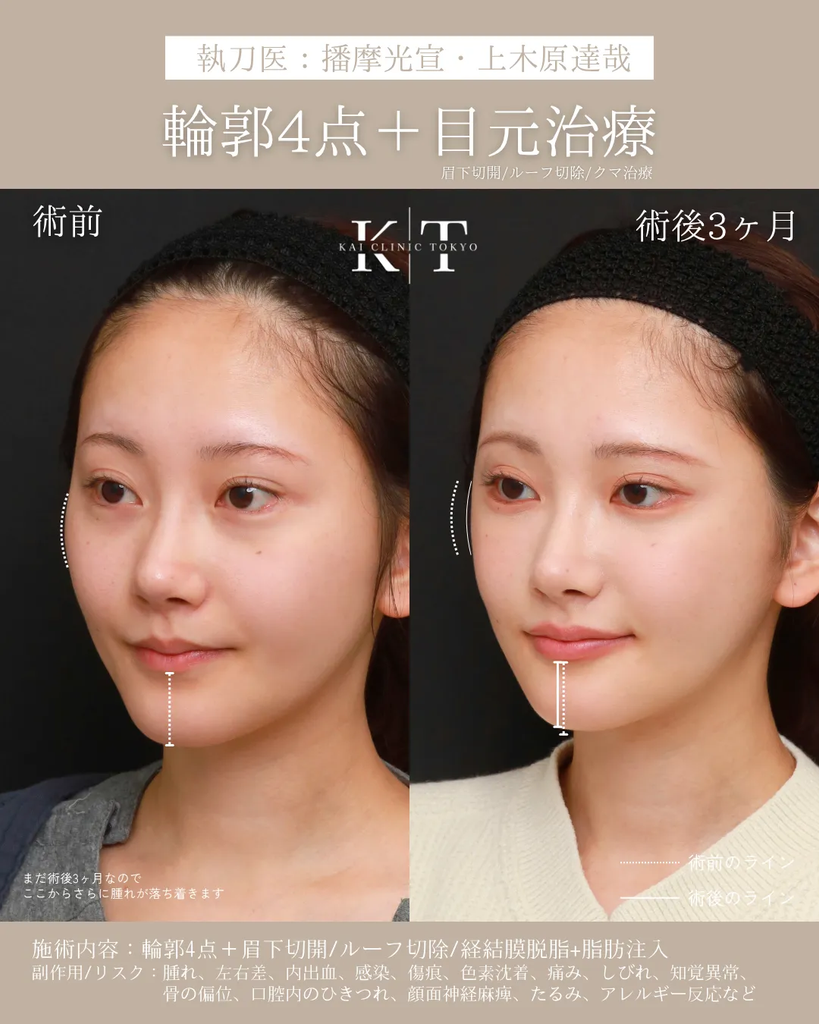 輪郭4点　目元治療　症例