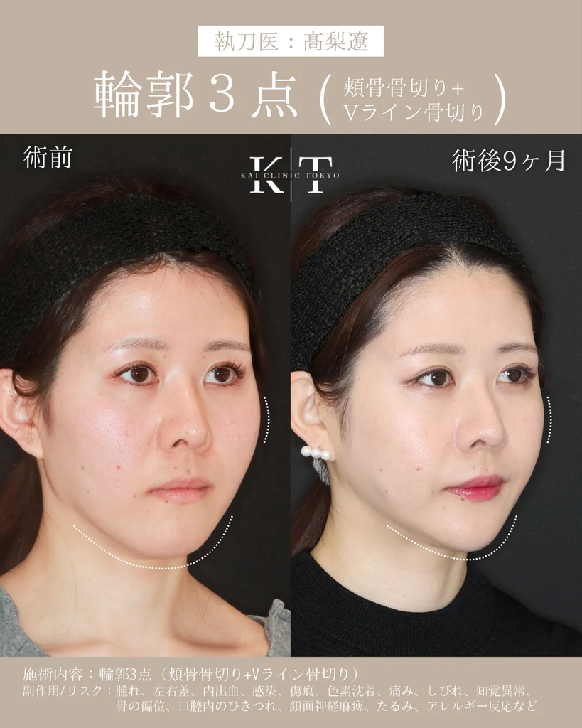 輪郭3点(頬骨骨切り+Vライン形成) 症例