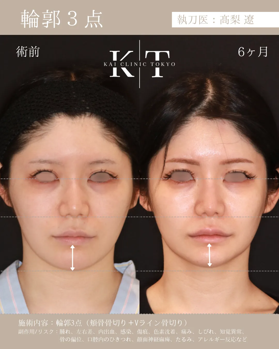 輪郭3点（頬骨骨切り＋Vライン骨切り）【女性】の症例写真