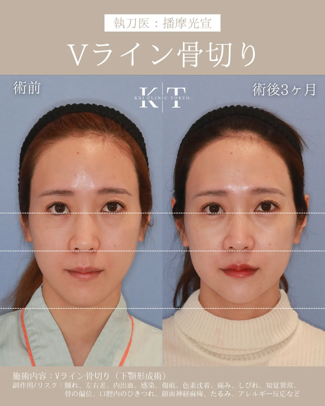 Vライン形成【20代女性】の症例写真